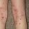 Severe Eczema On Legs
