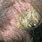 Severe Eczema On Scalp