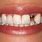 Single Tooth Dental Implant