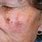 Skin Cancer Moles On Face