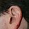 Skin Cancer On Outer Ear