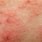 Skin Cancer or Eczema