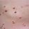 Skin Virus Molluscum