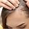 Symptoms of Alopecia