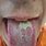Syphilis Rash Tongue