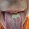Syphilis Tongue