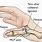 Thumb Joint Injury