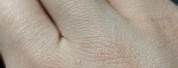 Tiny Clear Warts On Hands