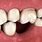 Tooth Bone Loss