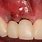 Tooth Implant Bone Graft