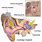 Types of Cochlear Implants