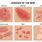 Types of Eczema Rash