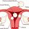 Types of Fibroid Uterus