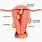 Uterine Fibroid Cysts