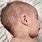 Viral Rashes in Babies