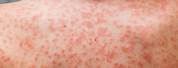 Viral Skin Rashes in Adults