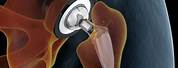 What Does a Hip Replacement Look Like