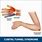 What Is Cubital Tunnel Syndrome