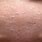 White Dry Bumps On Skin