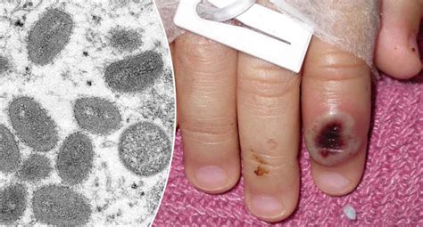 Doctor vows to leave medicine if killer Monkeypox virus spreads - Yahoo ...