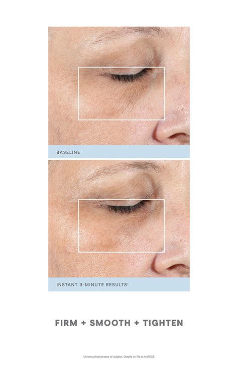 NuFACE® FIX® Starter Kit - Nude - Refurbished | Nordstromrack