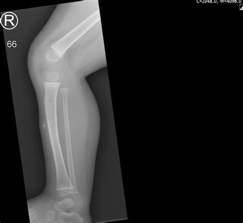 Lump By Shin Bone - Face Surgery