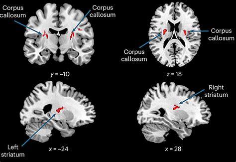 A common biomarker of schizophrenia and bipolar disorder revealed