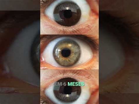 Ceratocone: Classificação Funcional para Conduta Clínica #shorts - YouTube