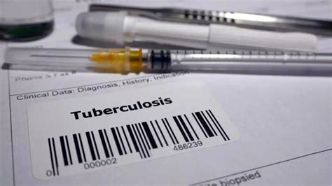 Kansas faces largest TB outbreak in history; warning signs and symptoms ...