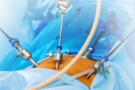 Preoperative CRP Predicts Surgical Complexity in acute calculous ...