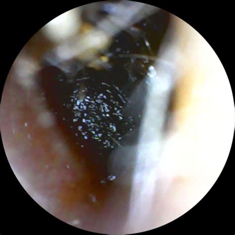 Ear Piercing Pain Diagram - Face Surgery