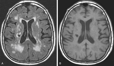 Understanding The 5 Stages Of Colon Cancer - Face Surgery