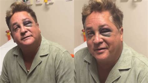 Leonardo aparece com olho roxo após queda e vai parar no hospital ...