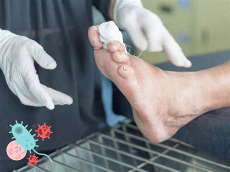 Las infecciones del pie diabético podrían ser causadas por bacterias ...