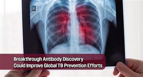 UT Southwestern Team Discovers How Antibodies Fight Tuberculosis - Mega ...