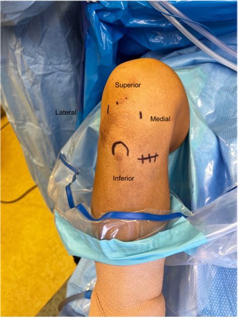 Generation of 5‐Strand Hamstring Autograft for Anterior Cruciate ...
