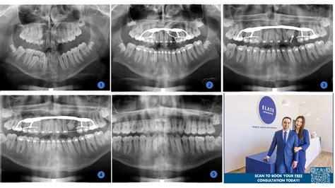 Impacted Teeth Treatment Frisco TX | Canine & Second Molar Impaction | Elate Orthodontics