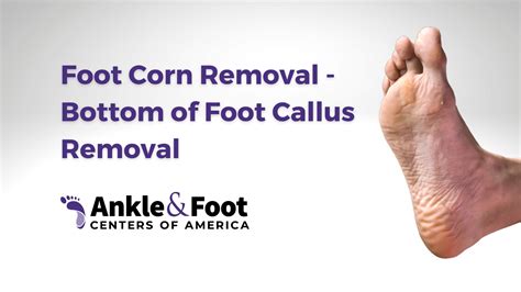 How to Remove Calluses from Feet Effectively ⋆ ctf.bnsf.com