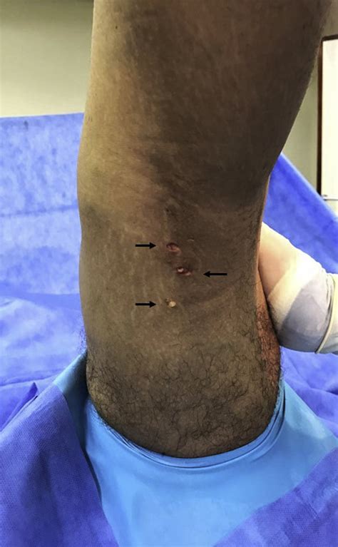Percutaneous Lengthening of a Regenerated Semitendinosus Tendon for ...