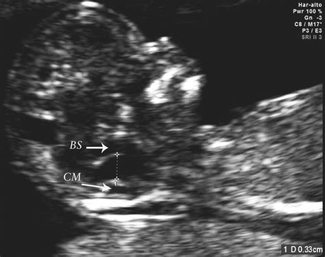Appearance of fetal posterior fossa at 11–14 weeks in fetuses with ...