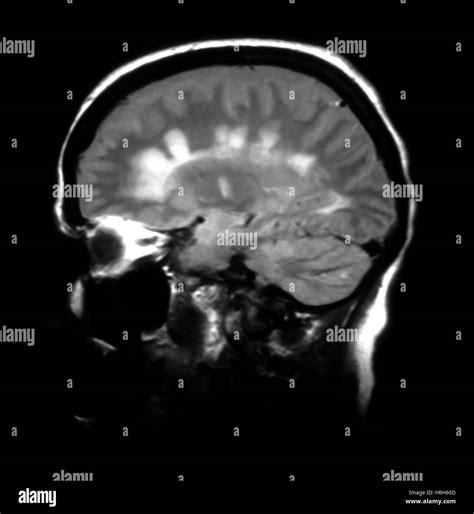 Multiple sclerosis disease Black and White Stock Photos & Images - Alamy