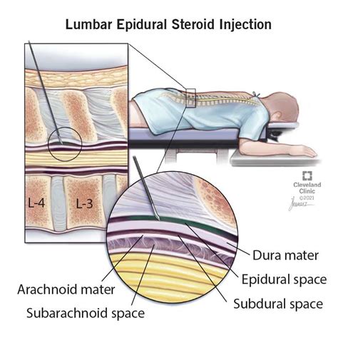 Lumbar Epidural Steroid Injections: What It Is, Benefits, Risks & Side ...