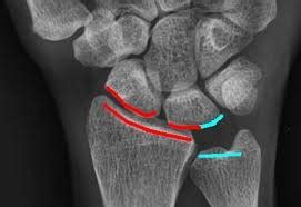 MSK I: Wrist and Hand Flashcards | Quizlet