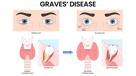 Thyroid Eye Disease: Effects on Eyesight & Eye Health