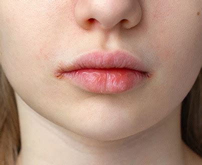 Cheilitis Treatment: Symptoms, Causes, Diagnosis, and Prevention