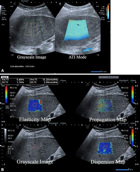 Ultrasound model predicts liver disease progress | Lisa Kiyohara, M.Ed, RDMS, RVT