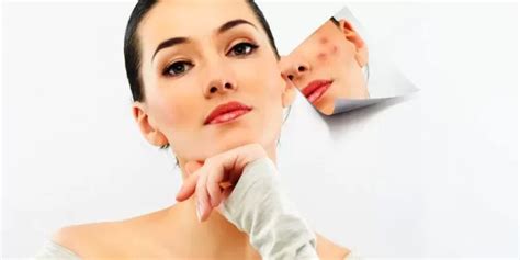 Ini Cara Alami dan Ampuh Hilangkan Bekas Jerawat di Wajah