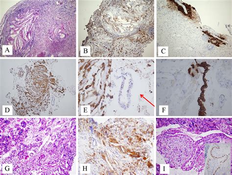 Secondary vs. primary pituitary xanthogranulomas: which yellow is more mellow?