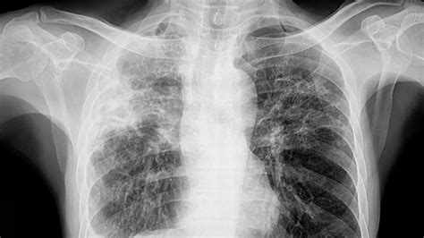 Maine CDC reports 3 active tuberculosis cases in Portland area