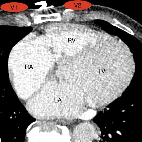 Anteroseptal OMI? Accurate ECG interpretation is essential to correctly interpreting the ...